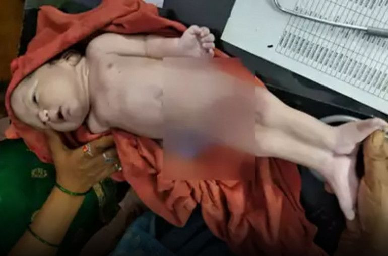 Hindistan'da doğan garip bebek doktorlar cinsiyetini tespit edemedi - Resim: 2