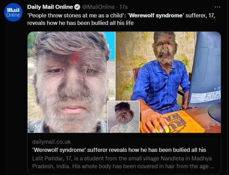 Sadece 50 kişide görülen hastalık! Kurt Adam hayat hikayesini anlattı: "İnsanlar üzerime taş atardı, hayalim Youtuber olmak" - Resim: 2