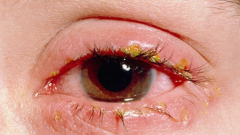 ABD'deki virüs salgınında 6 çocuk hayatını kaybetti - Resim: 1