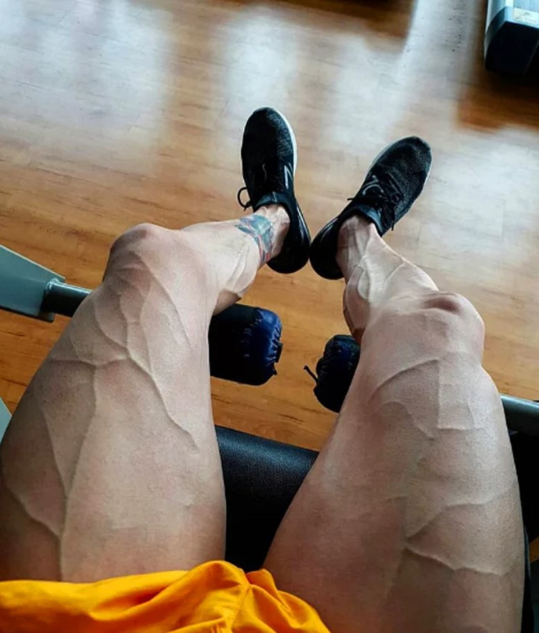 Damarlarınız diğer insanlara çok belirginse dikkat - Resim: 1