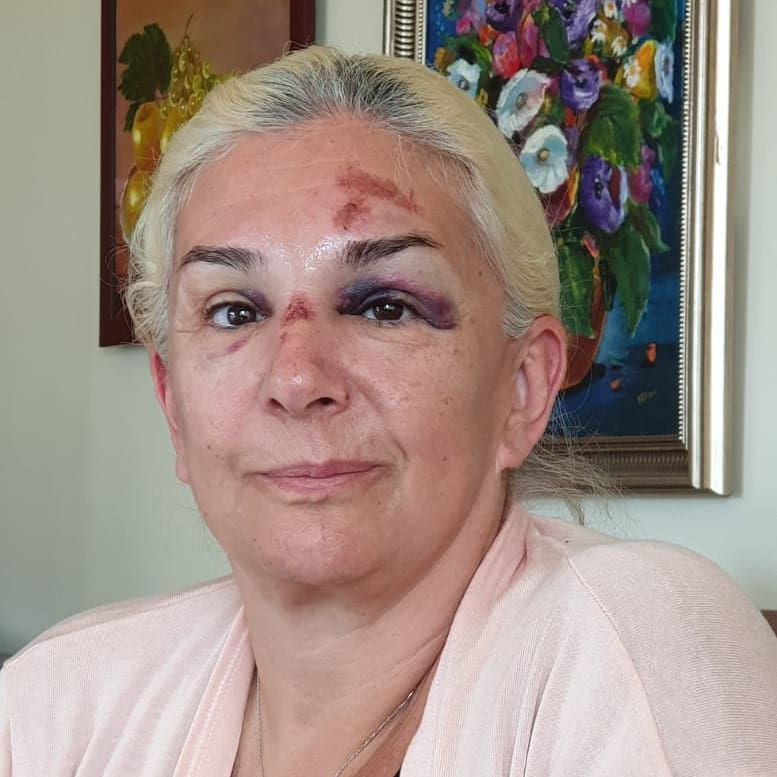 Burçin Orhon tanınmaz hale geldi Süheyl Uygur'un eşinin son görüntüsü korkunç - Resim: 3