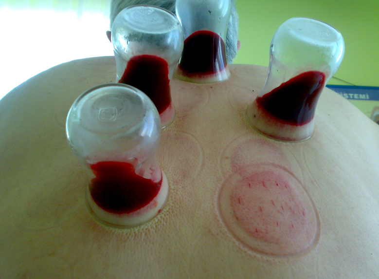 Peygamber sünneti olan hacamat nedir? - Resim: 3