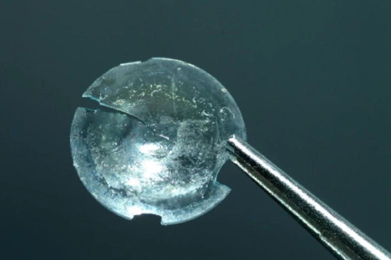 Gözüne sıkışan lensi 28 yıl fark etmedi - Resim: 4