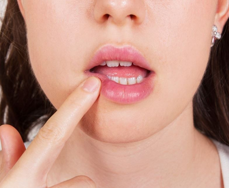 Aft nedir yemek yemeyi zorlaştırıyor sumak iyileştirir mi? - Resim: 1