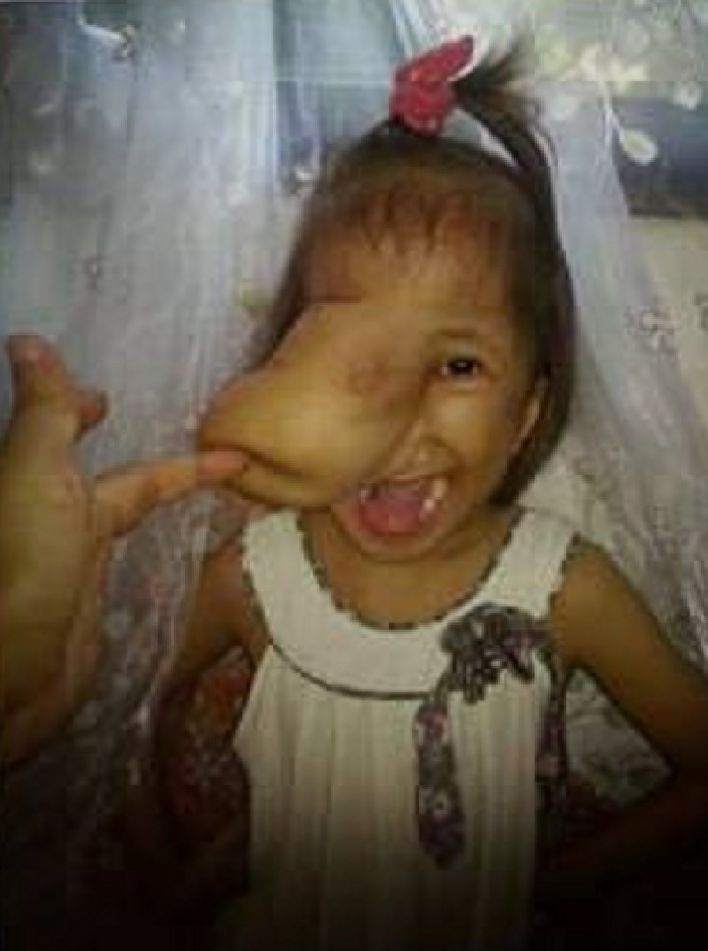 Yüzünde et parçasıyla doğdu! Son haline bakın - Resim: 4