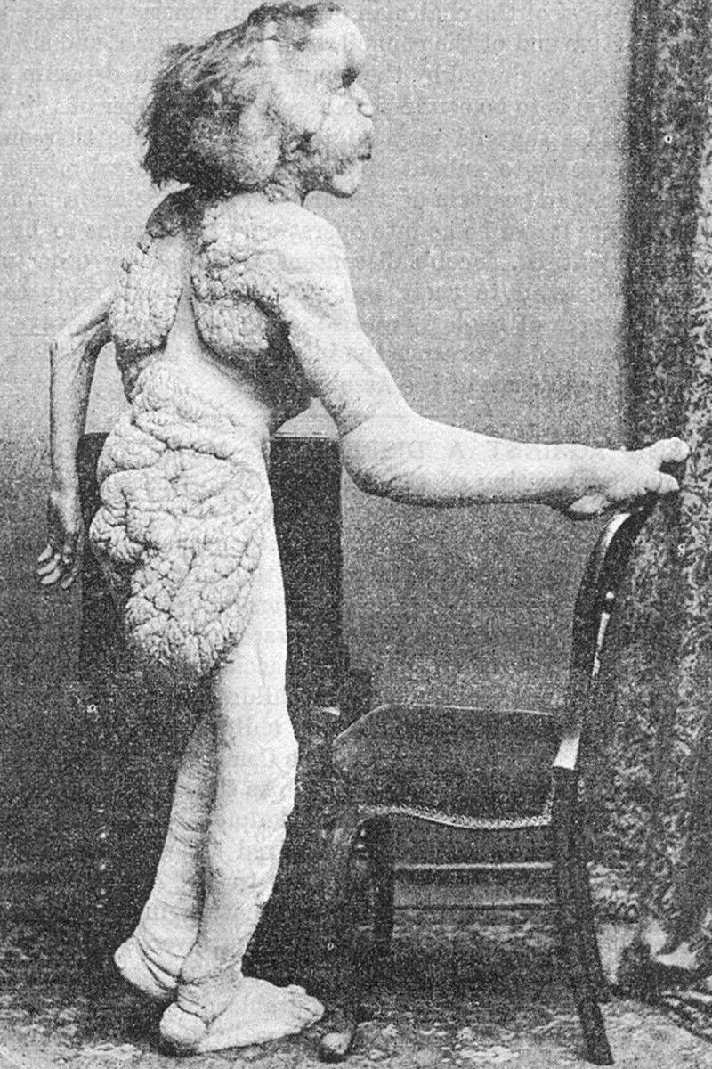 Fil Adam Joseph Merrick'in mezarının bulunduğu iddia edildi - Resim: 4