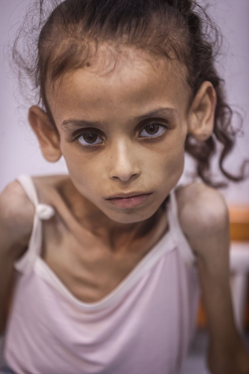 25 kilodan 10 kiloya düştü! Gazzeli Meryem'in son haline yürek dayanmıyor - Resim: 1