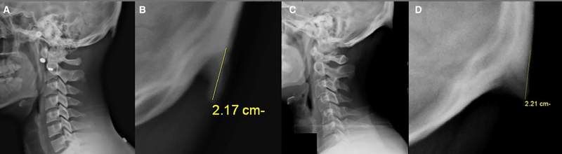 Aşırı cep telefonu kullanımı boynuz çıkıyor! - Resim: 4