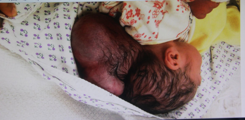 Hatay’da iki kafalı bebek dünyaya geldi - Resim: 1