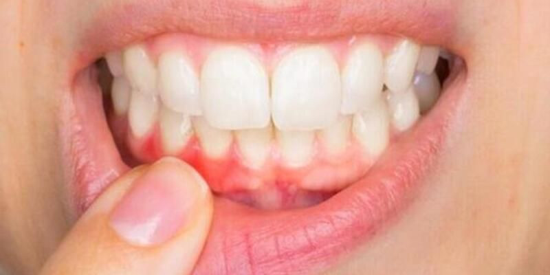 Diş eti iltihabı neden olur nasıl geçer? - Resim: 1
