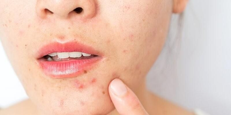 Sivilce nasıl geçer? Sivilcelerinizden kurtulmanın yolu bitkilerde saklı! - Resim: 2