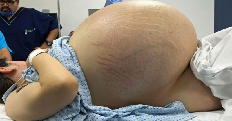 Karnı her geçen gün büyüdü herkes hamile sandı ama gerçek başka! - Resim: 1