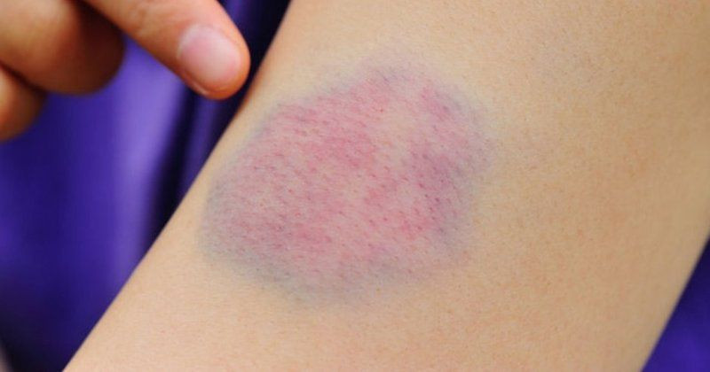 Ciltte morarma sebepleri morluklar nasıl geçer? - Resim: 1