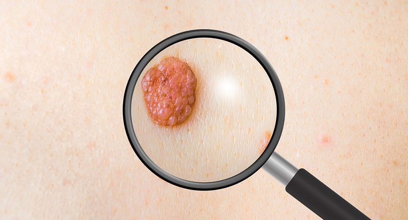 'Ben'inize dikkatlice bakın! Cilt kanseri olabilirsiniz işte belirtileri - Resim: 3