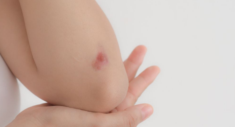 Vücudun verdiği bu sinyallere dikkat eğer sebepsiz morluklar varsa... - Resim: 3