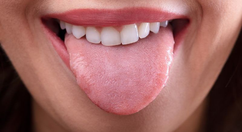 Dilde kabarcıklar neden olur? Nasıl geçer? - Resim: 2