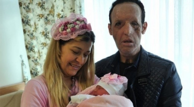 Yüz nakli olan Recep Sert baba oldu - Resim: 3