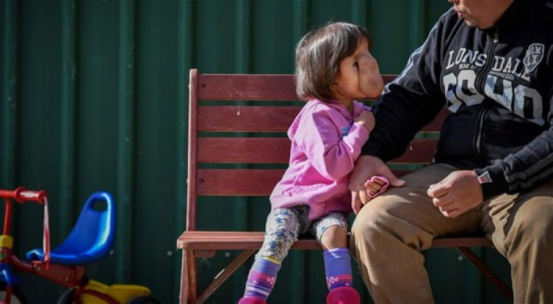 Yüzünde et parçasıyla doğdu! Son haline bakın - Resim: 3
