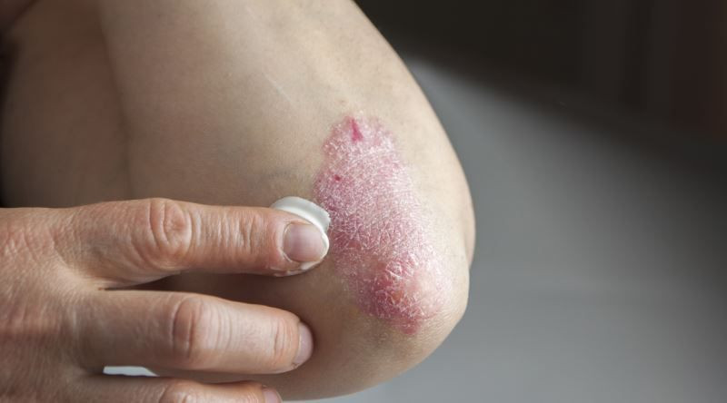 Egzamaya ne iyi gelir tedavisi nötral sabunları kullanın! - Resim: 2