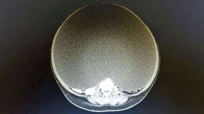 Karnı her geçen gün büyüdü herkes hamile sandı ama gerçek başka! - Resim: 2