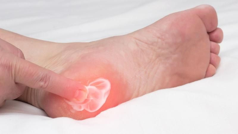 Uzmanından topuk dikenine dair uyarılar - Resim: 2