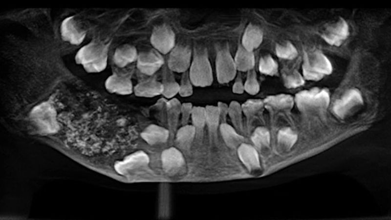 Çocuğun ağzında 526 diş bulundu tıp dünyasını şoke eden olay! - Resim: 2