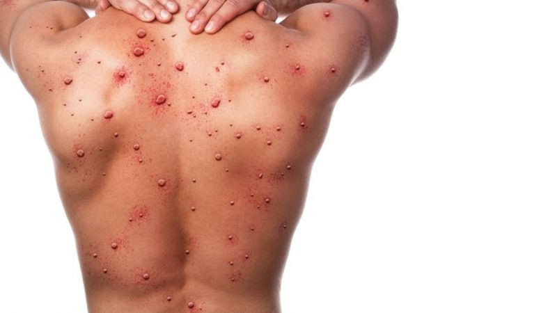 Sağlık Bakanlığı yayınladı maymun çiçeği belirtileri ve bulaşma yolları rehberi - Resim: 2