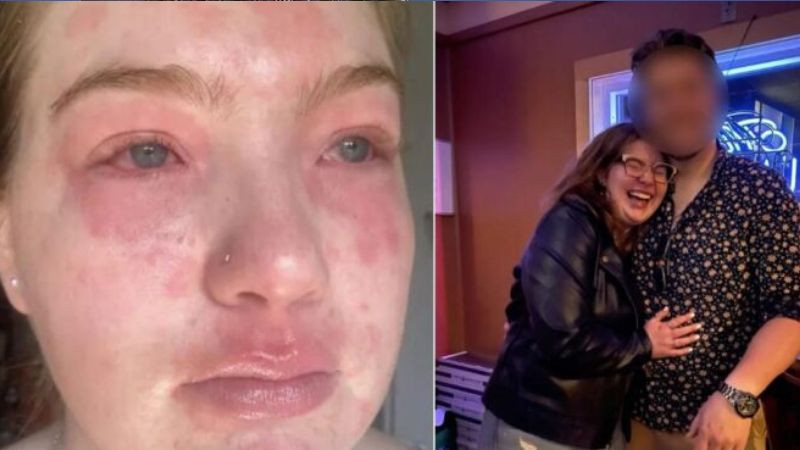 Erkek arkadaşınıza alerjiniz olabilir! Genç kadının ilginç hikayesi: Hastanelik bile oldu! - Resim: 1