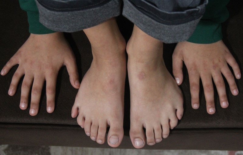 24 parmakla dünyaya gelen Demirhan için devlet harekete geçti - Resim: 1