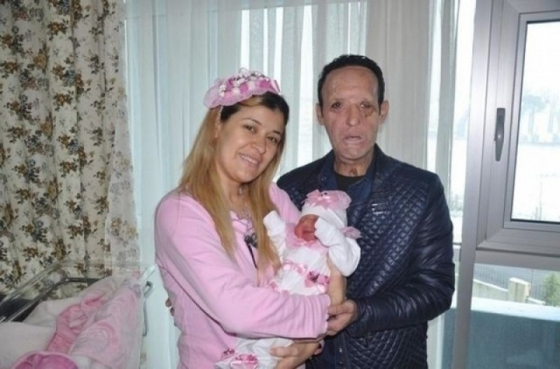 Yüz nakli olan Recep Sert baba oldu - Resim: 2