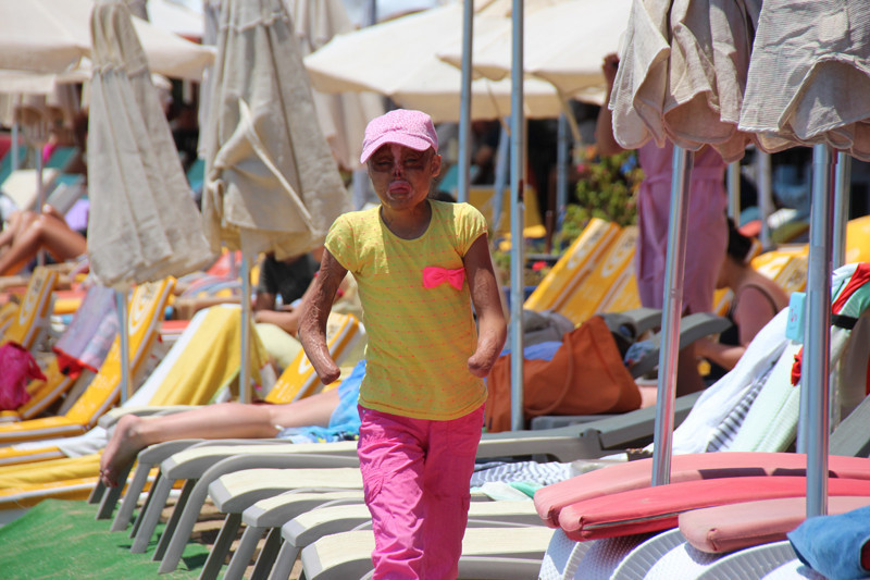 Yüzünü gören çocuklar köşe buçak kaçıyor - Resim: 2