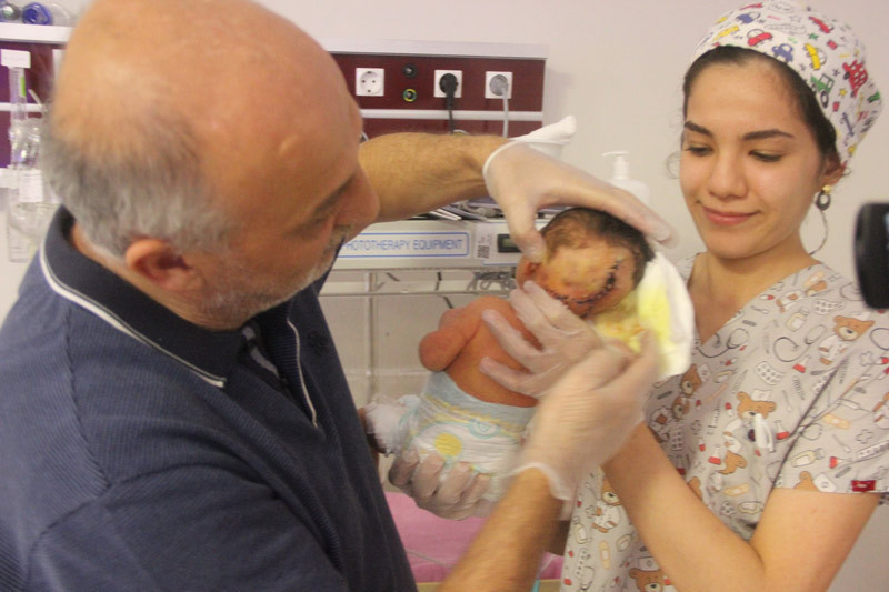 Hatay’da iki kafalı bebek dünyaya geldi - Resim: 4