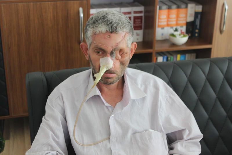 Ağrıyan dişini çektirdi yüzünün yarısı çöktü bir gözü kayboldu - Resim: 2