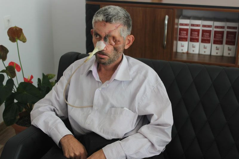 Ağrıyan dişini çektirdi yüzünün yarısı çöktü bir gözü kayboldu - Resim: 4