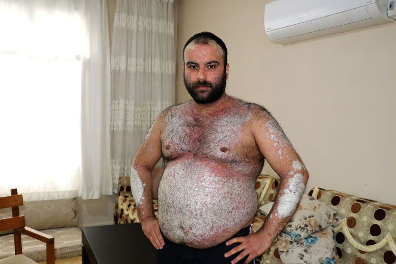 Hastalığı ilerledi kimse korkmasın diye sokağa çıkmıyor - Resim: 1