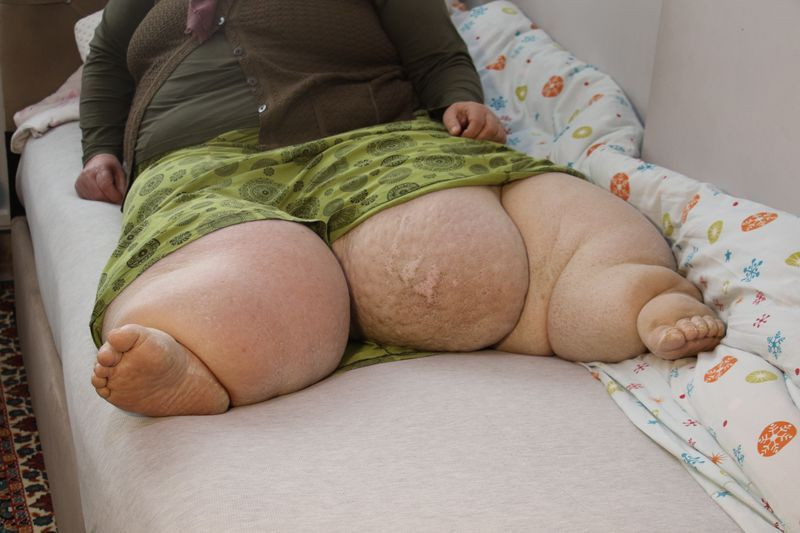 Ankara'da kılcal damarları koptu hayatı kabusa döndü! Her yıl daha çok şişiyor - Resim: 4