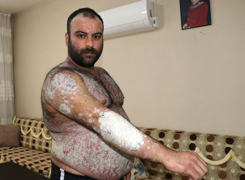 Hastalığı ilerledi kimse korkmasın diye sokağa çıkmıyor - Resim: 2