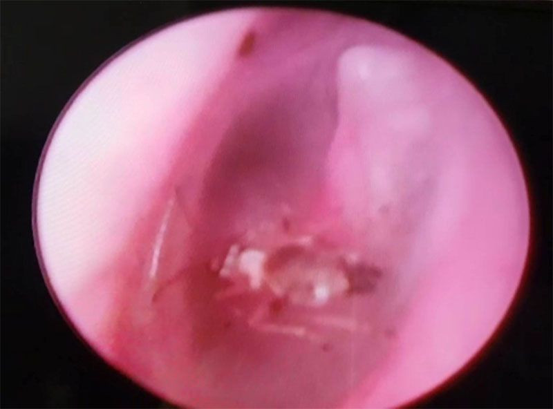 Manisa'da doktor hastanın kulağından canlı çıkardı - Resim: 1