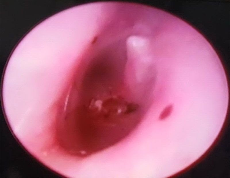 Manisa'da doktor hastanın kulağından canlı çıkardı - Resim: 3