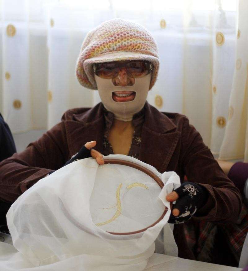 Yüzü yanan kadın ailesinin desteğiyle hayata tutundu - Resim: 4