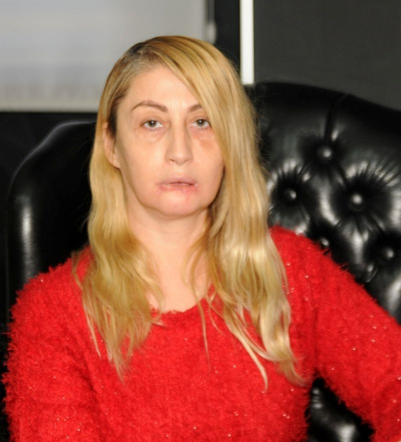 4 kez dolgu yaptırdığı alt dudağı koptu! Şimdi yeniden yaptırıyor - Resim: 1