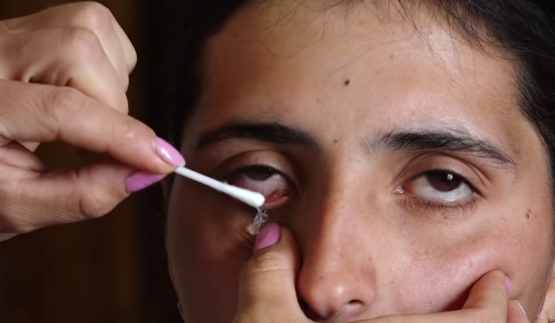 Doktorlar çare bulamadı gözünden yaş yerine kristal damlıyor - Resim: 1