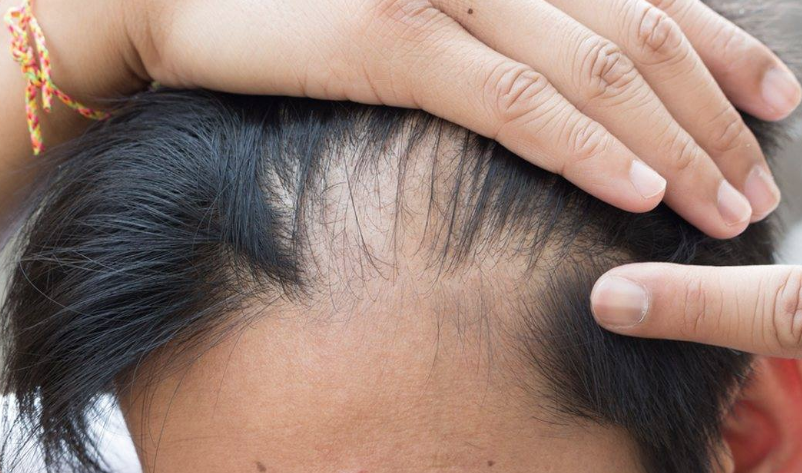 Saç ekimi yapacaklar dikkat! Bu 4 aşamayı dikkate almazsanız... - Resim: 4