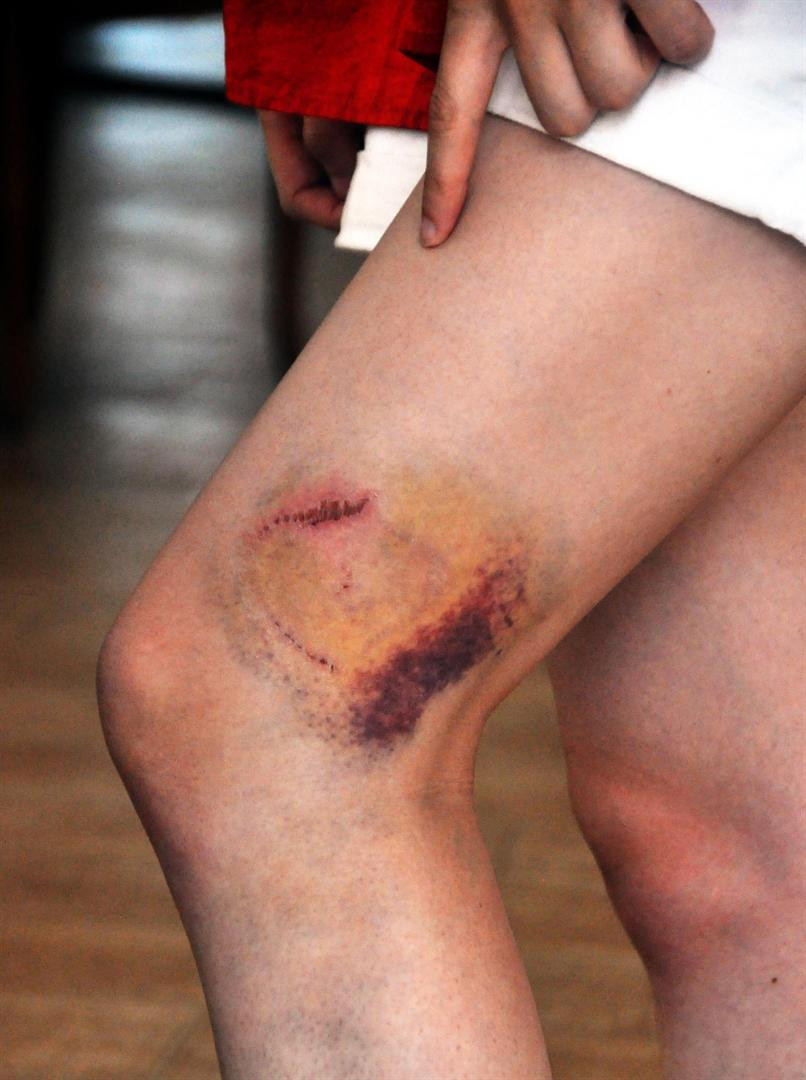 Caretta carettalar ısırdı onlar böyle poz verdi - Resim: 3