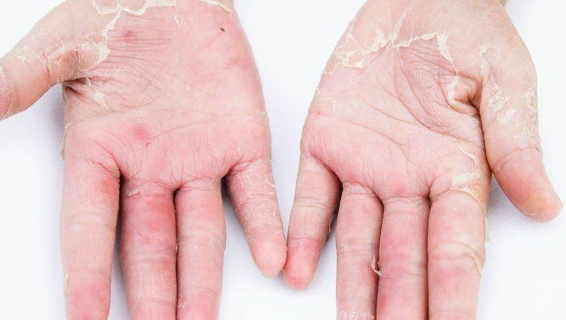 Fazla kolonya kullanımı egzamaya neden oluyor! - Resim: 2