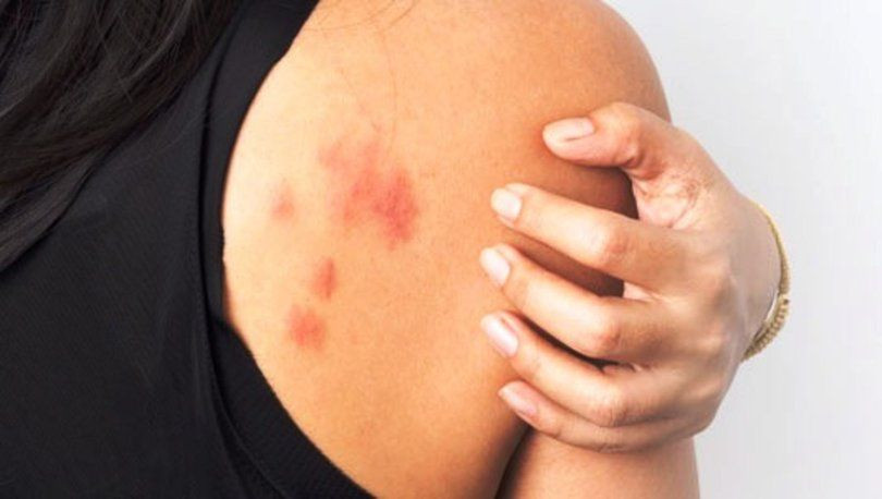 Baharda sık görülen 5 cilt hastalığı! Cildinizde kaşıntı ve kızarıklık varsa... - Resim: 4