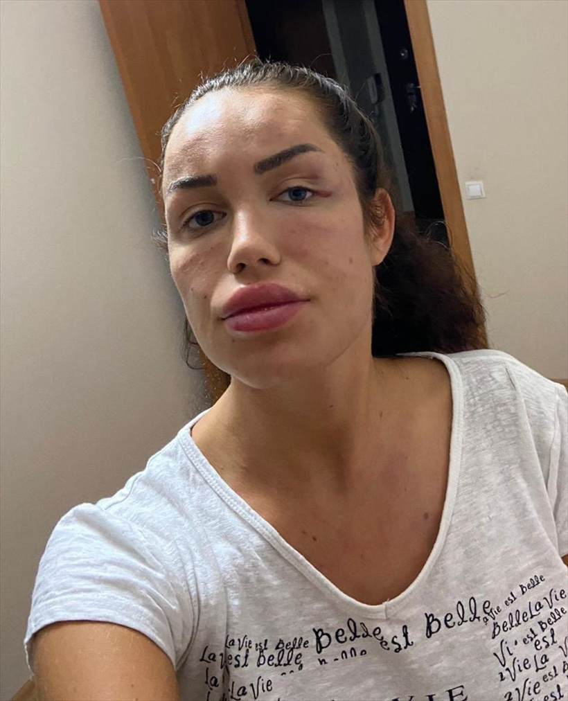 İzmir'de 'gençlik aşısı' hayatını kararttı 200 tane iğne vurdular bu hale geldi - Resim: 3