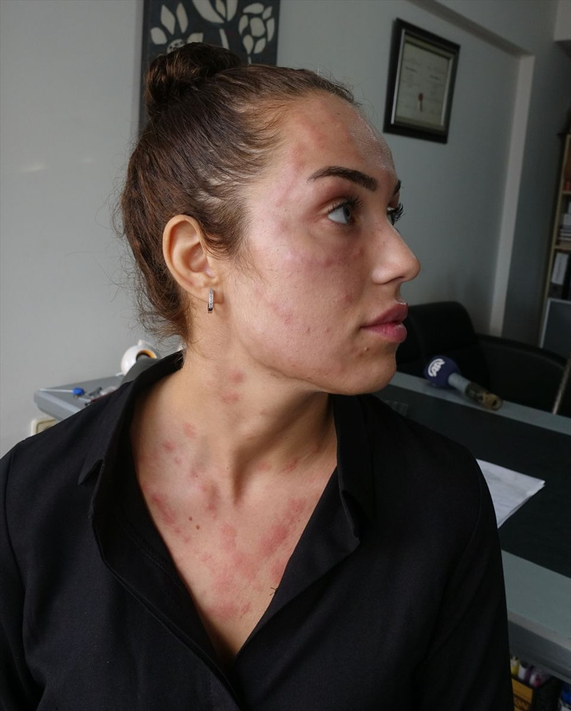 İzmir'de 'gençlik aşısı' hayatını kararttı 200 tane iğne vurdular bu hale geldi - Resim: 4