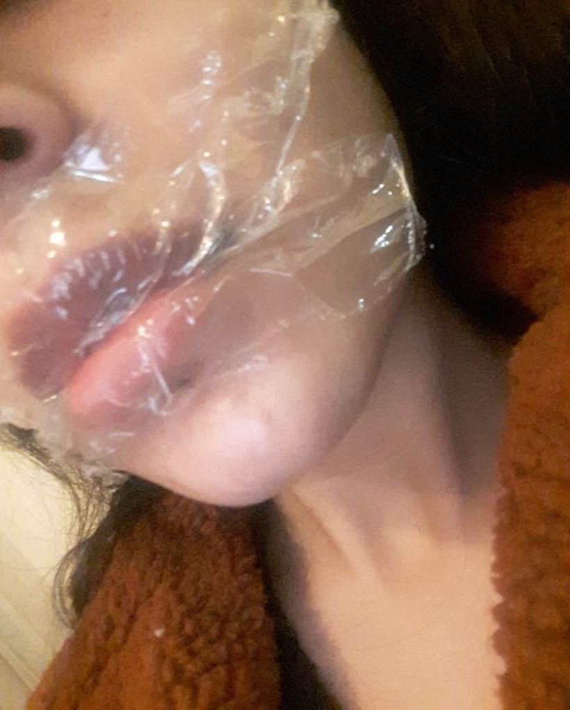 Merdivenaltı rezalet! Koronalı botoks partisinde dudağından oluyordu - Resim: 1