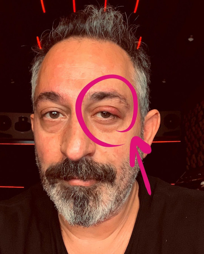 Cem Yılmaz'ın gözüne ne oldu? Paylaşımı hayranlarını şoke etti - Resim: 3